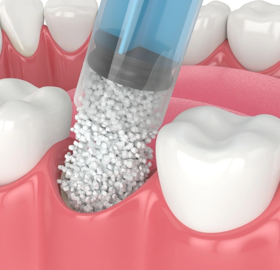 Dental bone grafting procedure illustration