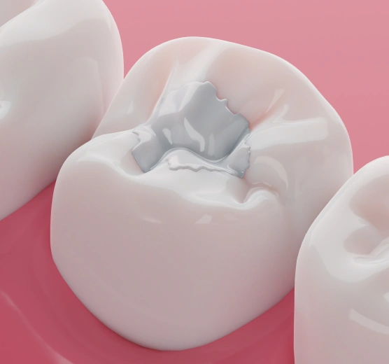 Illustration of a tooth with a composite filling
