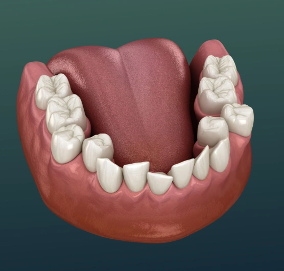 Dental illustration showing crowded teeth correction