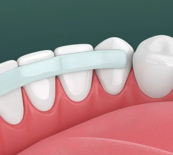 Illustration of dental bonding treatment showing a tooth being bonded with composite resin material.