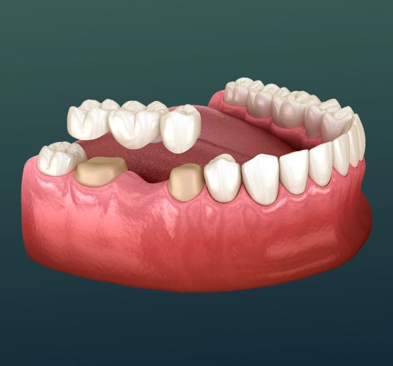Dental bridge replacing missing teeth