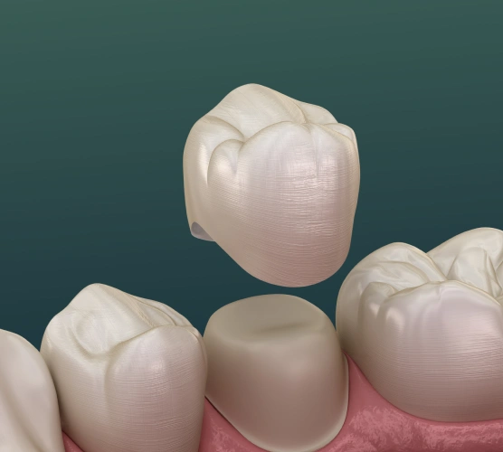Illustration of dental crowns placed on teeth