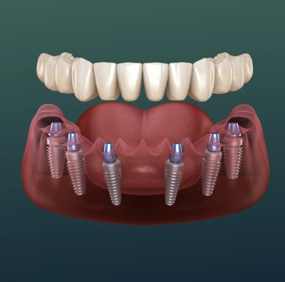 Illustration showing dental implants replacing missing teeth