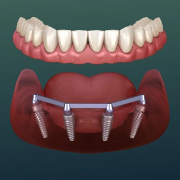Full-arch dental implants and All-on-4 treatment illustration