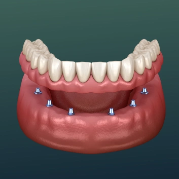 Implant-supported dentures illustration