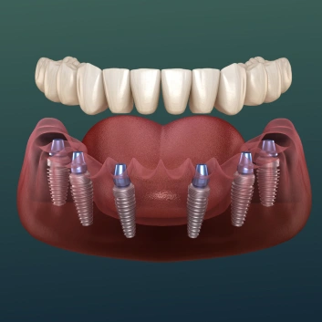 Dental implants replacing missing teeth illustration
