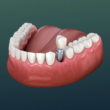 Single-tooth dental implant replacing a missing tooth
