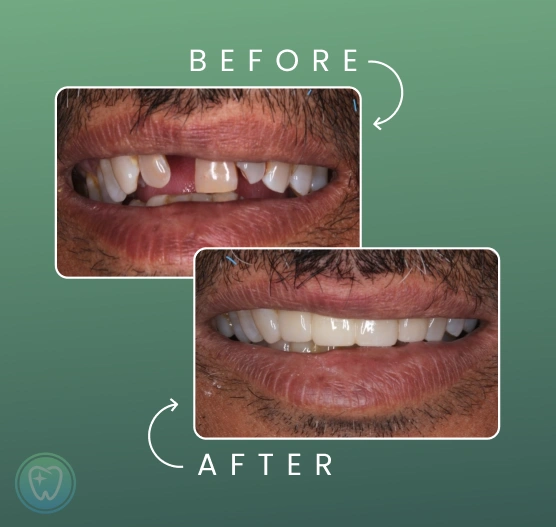 teeth before and after implant teatment