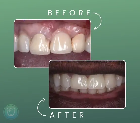 Before and after dental veneers treatment showing improved tooth alignment and brightness.