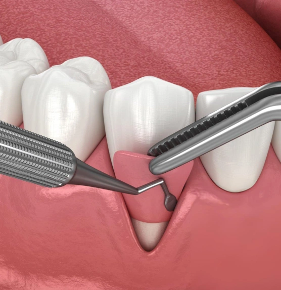 Gum grafting procedure illustration
