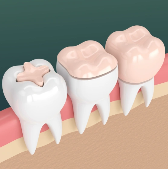 Illustration of dental inlays and onlays fitted onto teeth
