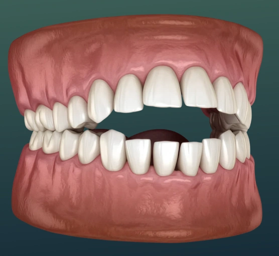 Illustration showing open bite correction