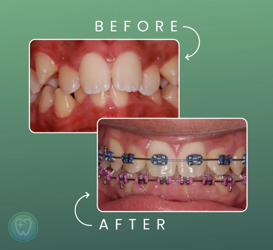 Before-and-after comparison showing teeth alignment improvement with orthodontic treatment