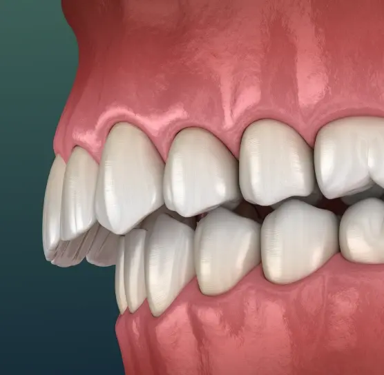 3D illustration of overbite correction showing upper front teeth overlapping lower teeth before treatment.