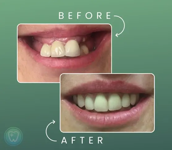 Before and after smile makeover showing improved tooth alignment and whiteness.