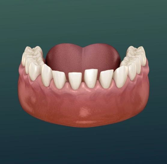 Illustration of a dental space maintainer
