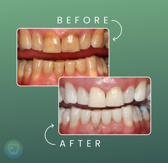 Before-and-after comparison showing teeth becoming visibly whiter after whitening treatment