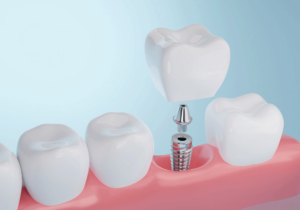 Dental Implant Being Fitted into Jaw Showing Post Abutment and Crown