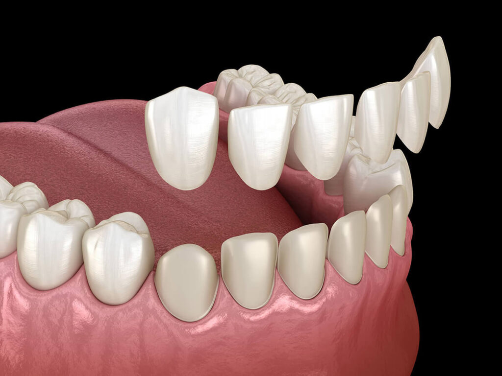 3D dental illustration of dental veneers being placed on front teeth to enhance aesthetics and correct imperfections.