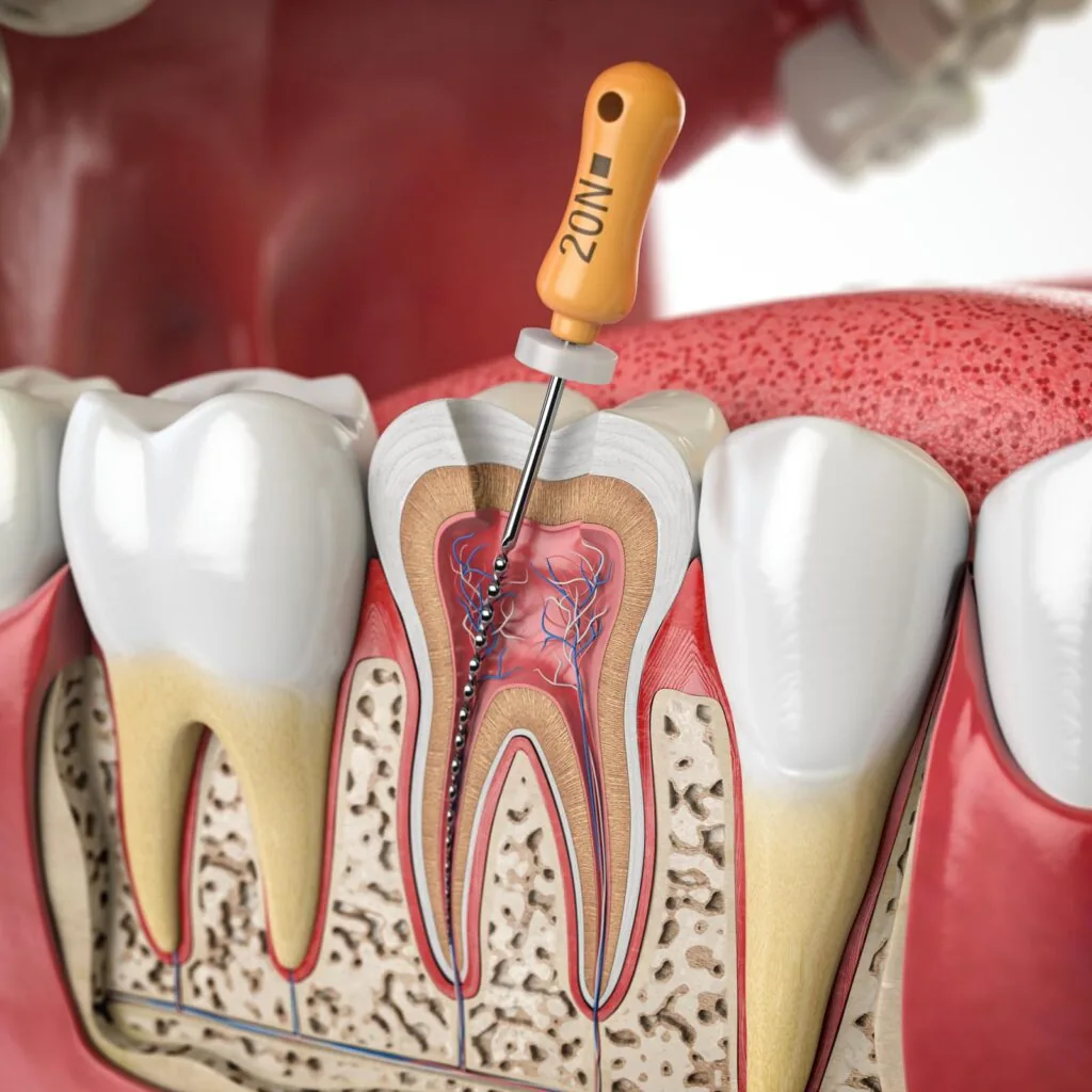 3D dental illustration of a root canal procedure showing an endodontic file cleaning the infected pulp inside a tooth.