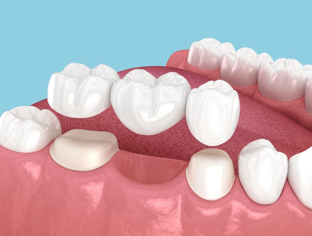 Dental bridge illustration showing a three-unit porcelain bridge replacing a missing molar, supported by two dental crowns on adjacent teeth.