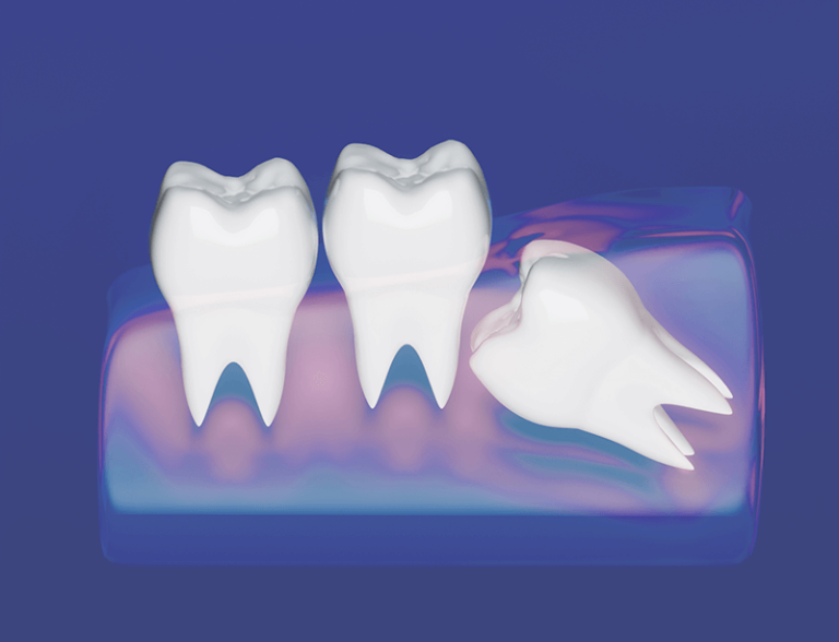 illustration of a wisdom tooth embedded under a gum