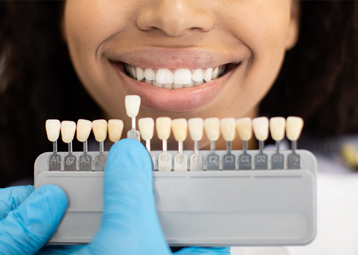 sample of veneer tooth colors being held up to match the tooth color of a smiling patient