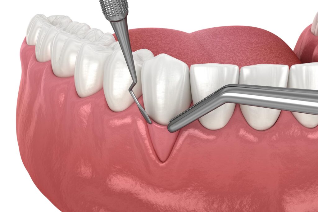 Dental illustration showing gum recession treatment using periodontal instruments to remove plaque and tartar buildup below the gumline.