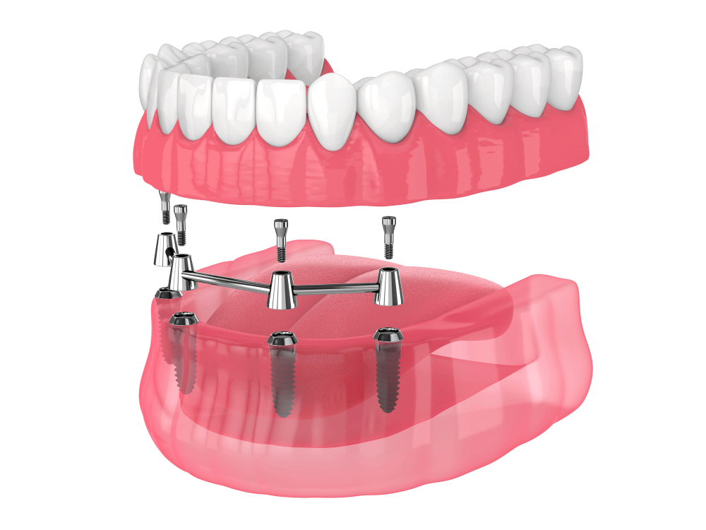 All On 4 Dental Implant