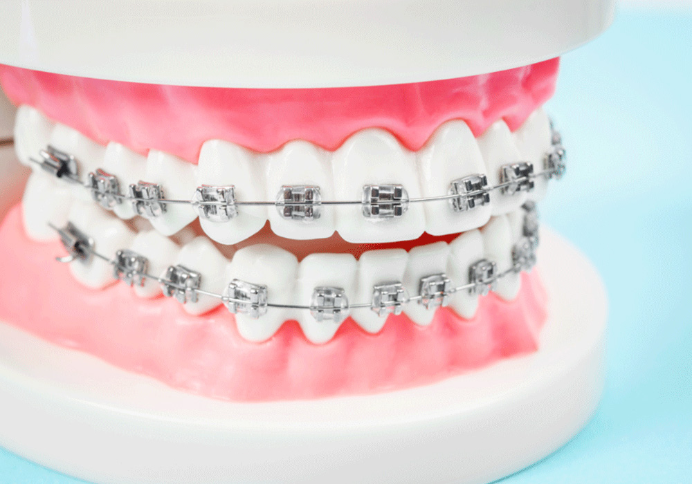 jaw model with two rows of metal dental braces on the upper and lower rows of teeth