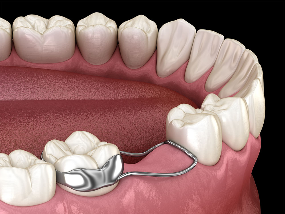The image shows a dental appliance known as a space maintainer. This device is used in pediatric dentistry to hold space for permanent teeth when a primary tooth has been lost prematurely. It consists of a metal band attached to one of the molars and a loop extending to maintain the space where the missing tooth was located.