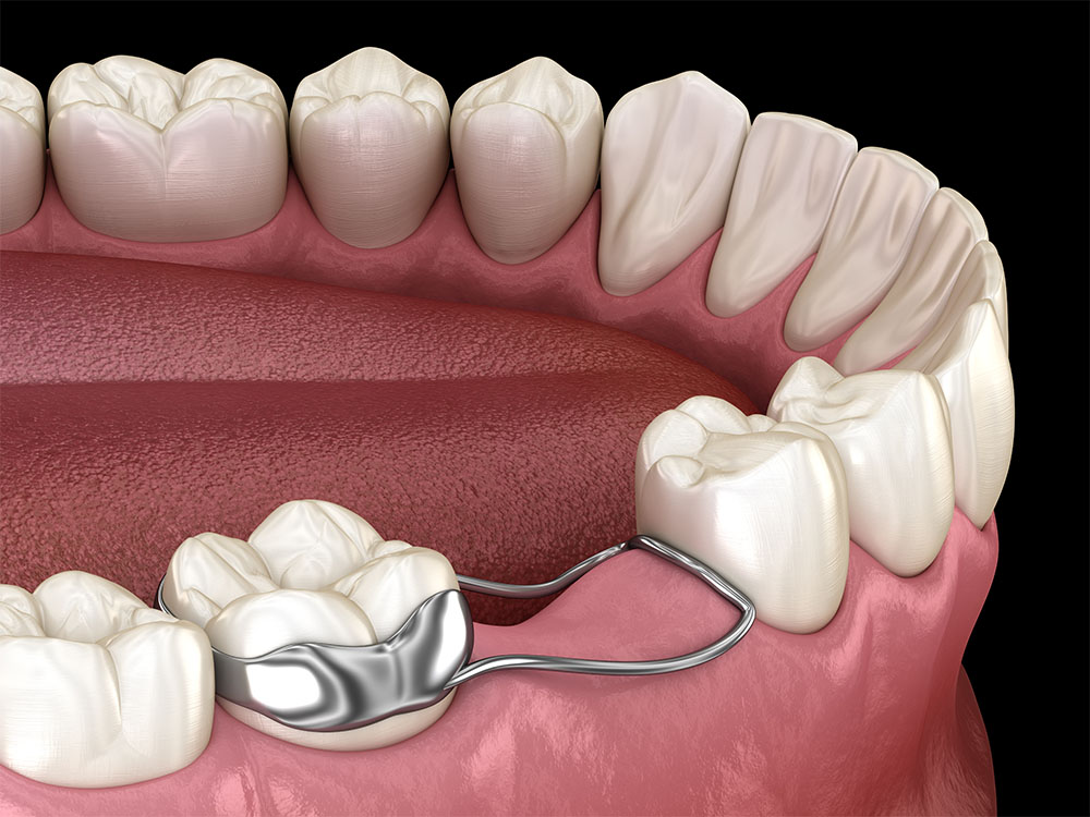 visual mockup of a bottom row of teeth using a spacer