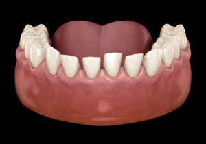 visual mockup of mis-spaced teeth