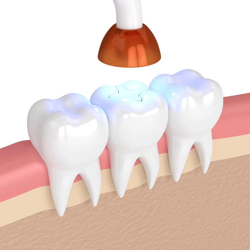 illustration of dental filling being sealed inside a tooth