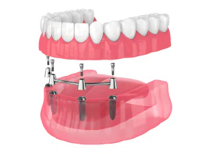 Dental implant frequently asked questions at Pearl Shine Dental in Houston, TX
