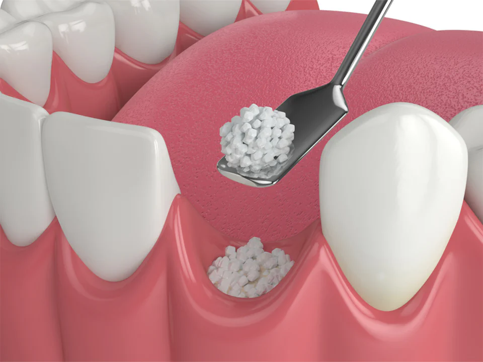 Dental Bone Grafting at Pearl Shine Dental in Houston, TX