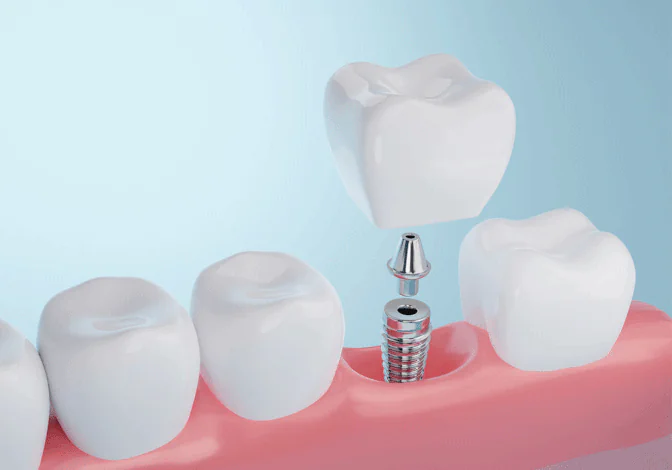 Dental implants available at Pearl Shine Dental in Houston, TX