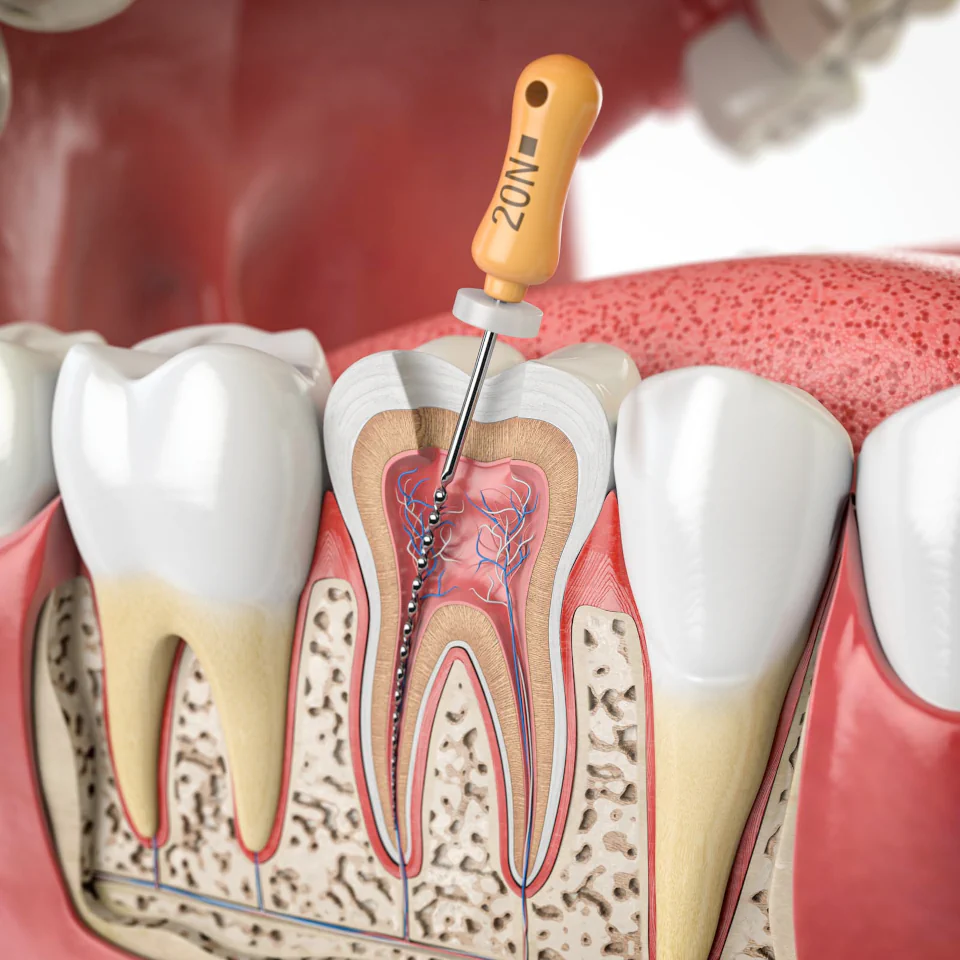 Root canal treatments at Pearl Shine Dental in Houston, TX